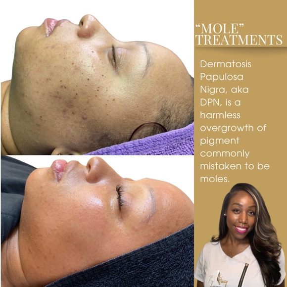 Mole Removal